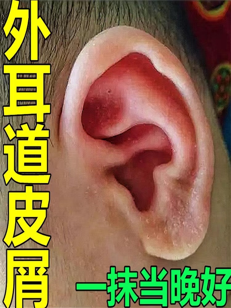 耳朵起皮痒干燥痒专用外耳道起皮屑红痒脱皮干燥抑菌止痒软膏