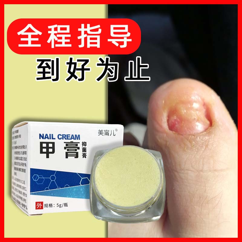 美甯儿【全程指导 】软甲膏脱甲膏灰指趾甲厚甲外用膏软膏套装