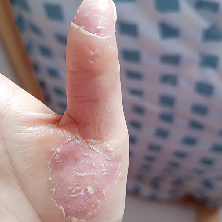 严重脱皮手指手心起皮干皮反复手指蜕皮爆皮干燥滋润防裂护理软膏