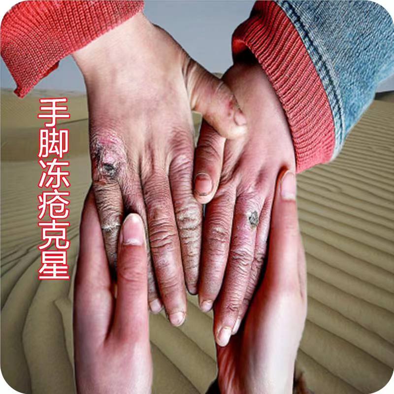 手脚严重裂口疼皴裂防冻防干裂消肿止痒防冻皲裂膏