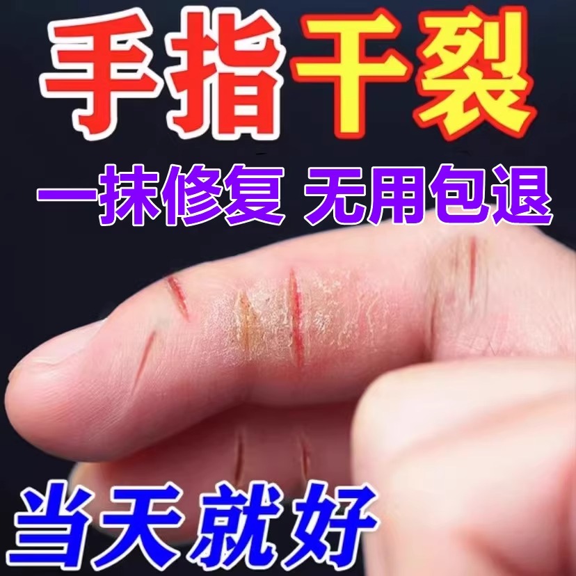 手指头裂口子干裂修复护手霜开裂脱皮裂开手足开口手脚马油皲裂膏