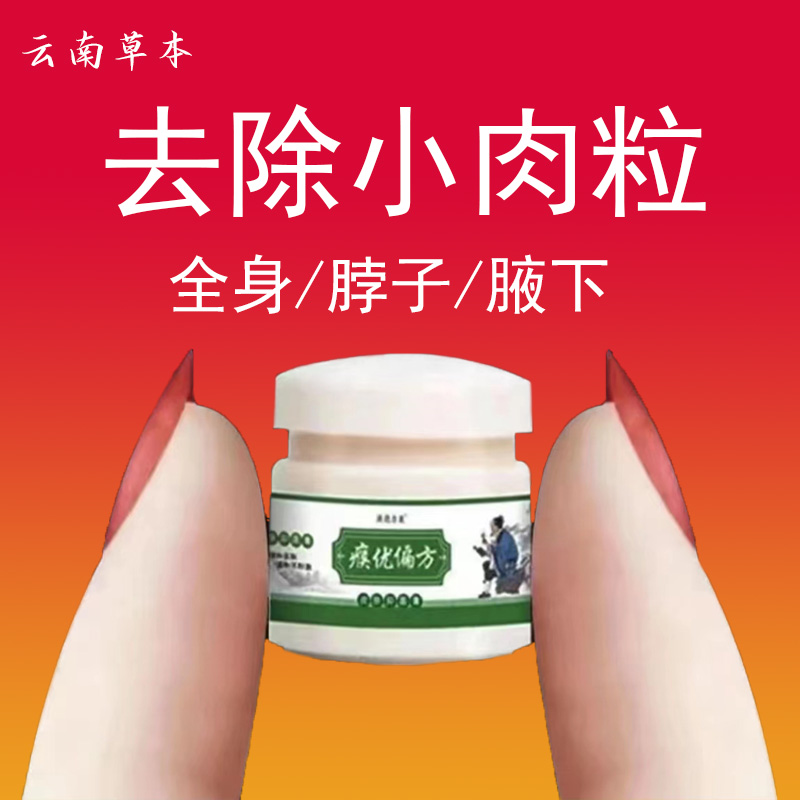 【官方正品】包邮云南本草脖子长肉粒怎么办硬皮茧手茧本草膏软膏