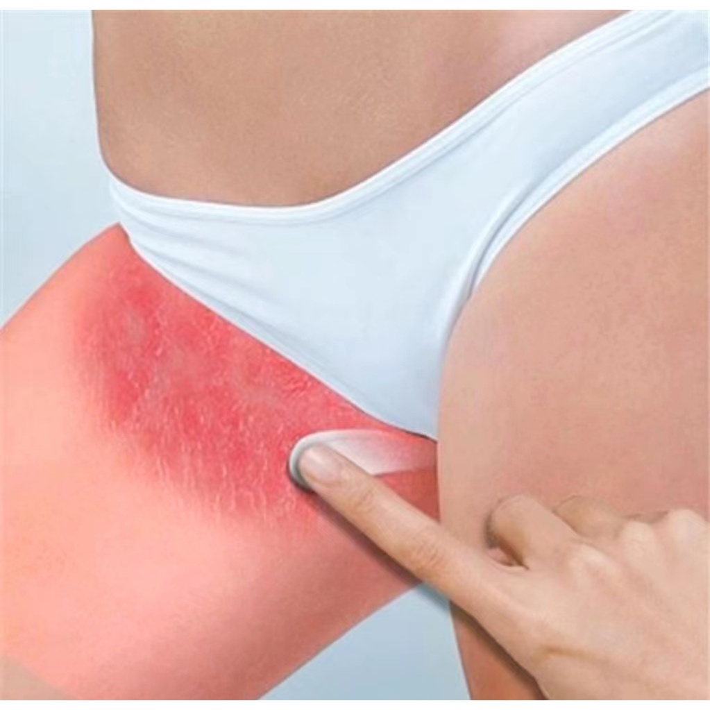 大腿内侧痒大腿根痛股红起小疙瘩发红大腿根发黑舒缓软膏清洁涂抹