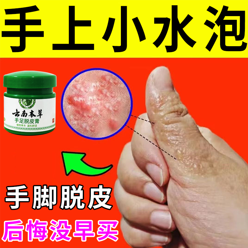 云南本草手足脱皮膏20g/盒 草本萃取涂抹温和外用手脚部脱皮干裂